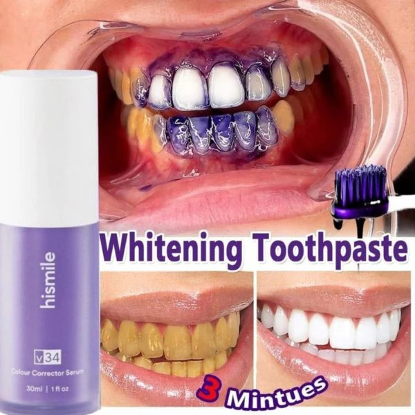 Hismile v34 Teeth Whitening